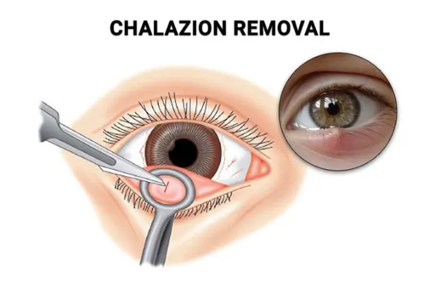How To Treat a Chalazion Effectively