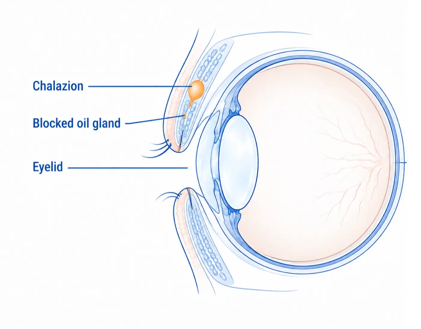 Illustration of a chalazion: a blocked oil gland forming a lump deeper within the eyelid