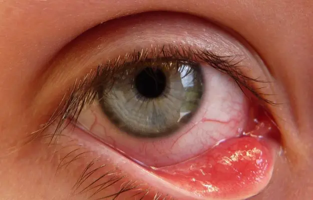 Chalazion: Understand Clearly, Treat Correctly &amp; Prevent Recurrence