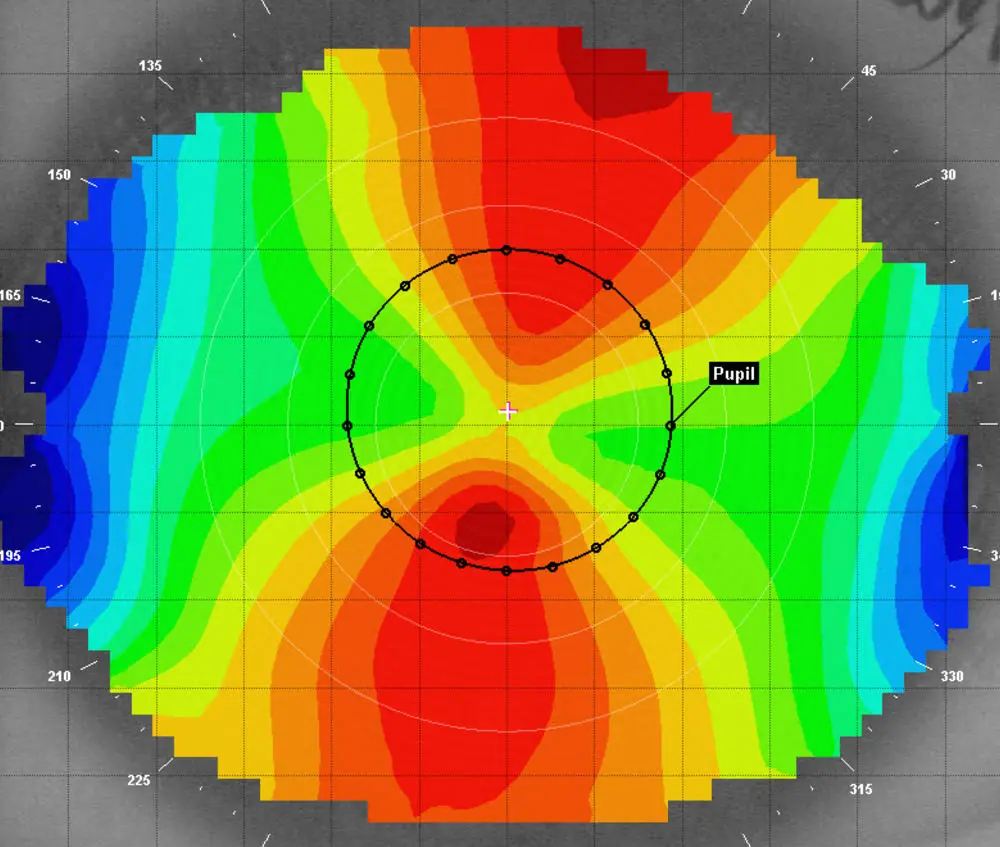 Corneal topography map showing astigmatism pattern with colour-coded regions