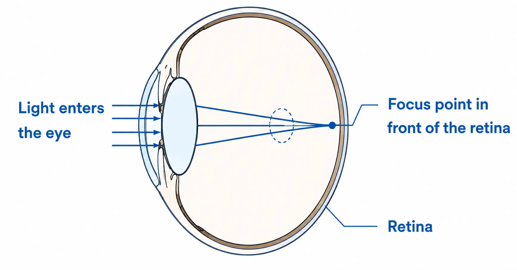 Cross-section diagram of a myopic eye showing light focusing in front of the retina