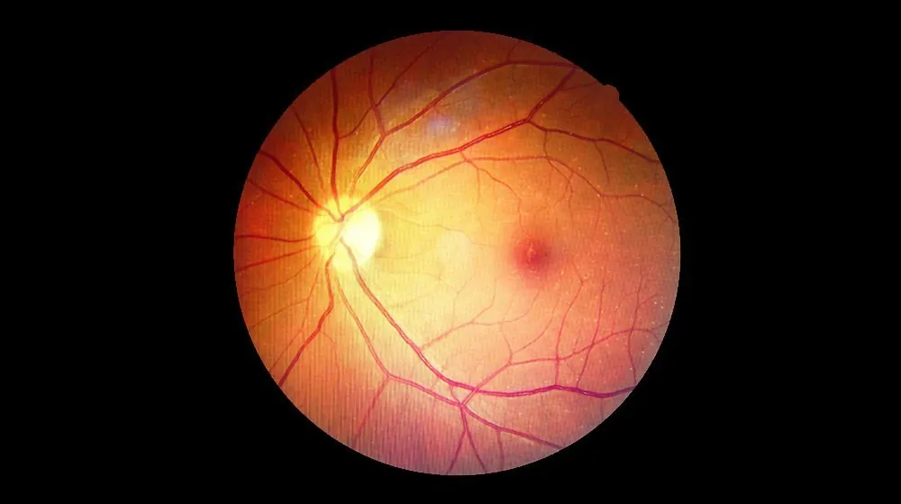 Lỗ Hoàng Điểm (Macular Hole): Dấu Hiệu, Nguyên Nhân, Chẩn Đoán &amp; Điều Trị Hiệu Quả