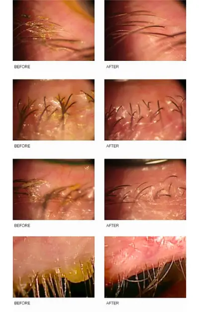 Quy Trình Điều Trị Viêm Bờ Mi Bằng BlephEx