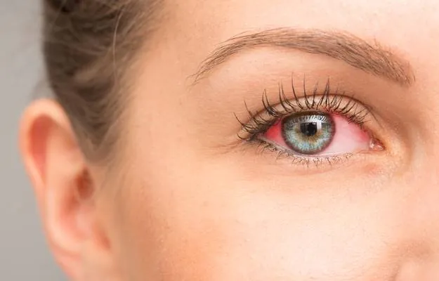 lady having red eye close up dry eye symptoms Everything You Need to Know About Dry Eye Syndrom body ss