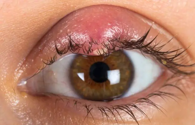 Lẹo Mắt (Stye): Dấu Hiệu, Nguyên Nhân &amp; Cách Điều Trị Hiệu Quả