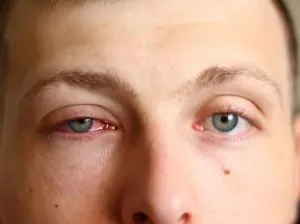 pink eye image 2