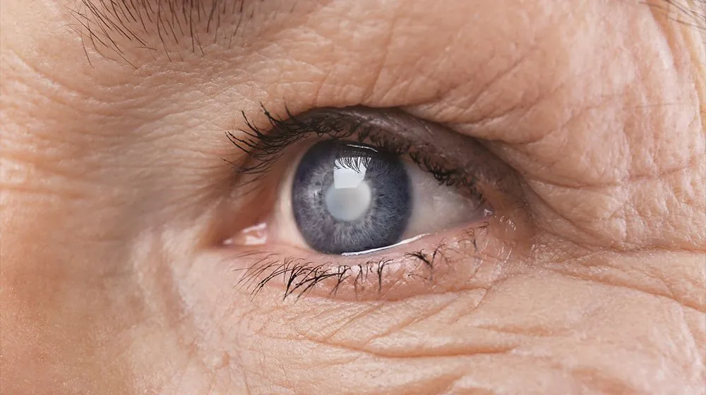 Tăng Nhãn Áp (Glaucoma): Dấu Hiệu Sớm, Nguyên Nhân, Chẩn Đoán &amp; Điều Trị