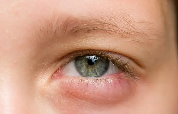 What is a Swollen Eye