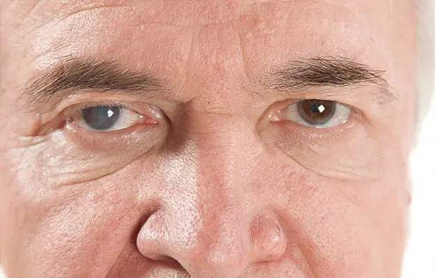 Tăng Nhãn Áp (Glaucoma) Là Gì?