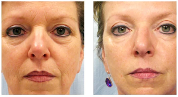 Tixel-Before-and-After-1