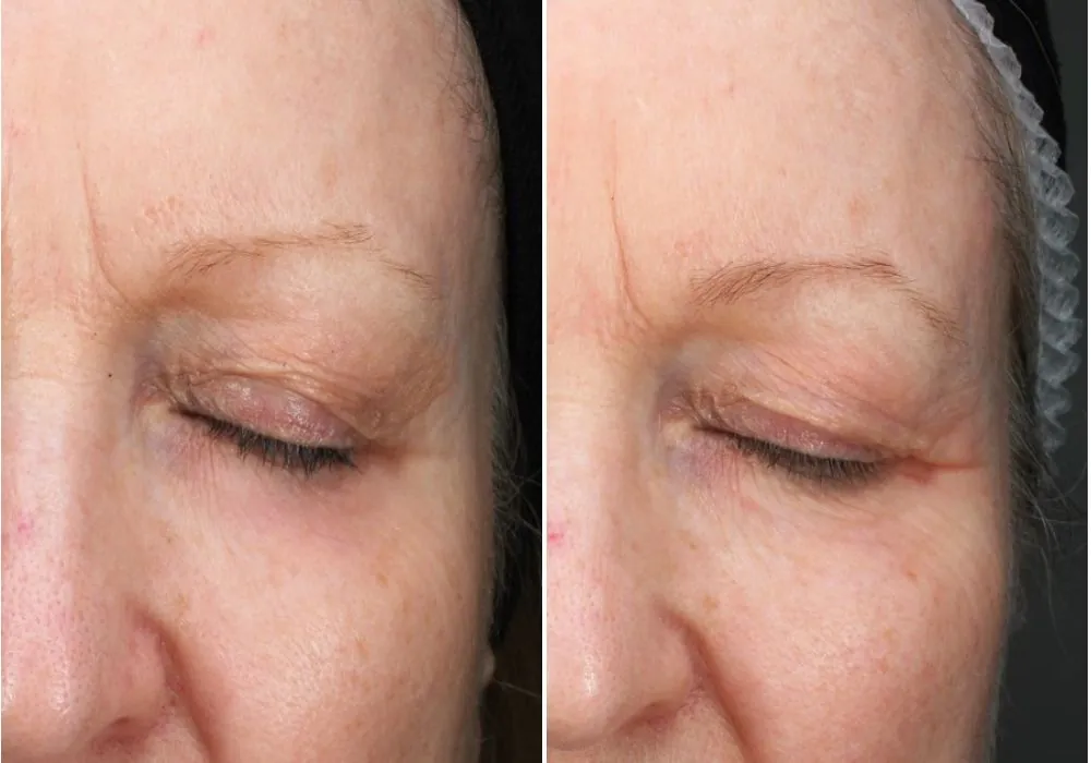 Tixel results-before and after treatment