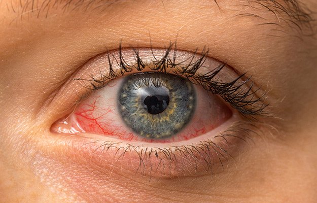 Dry and red eye | "Dry eye disease is a common ophthalmic condition. The question is, did dry eye patients struggle with the current pandemic? And does the deadly coronavirus play a role in making us more prone to dry eyes?