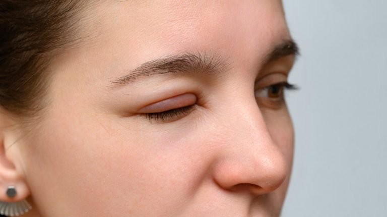 Woman-with-swollen-eye---------Swollen-Eyes---Causes-and-Treatments---------ss_feature