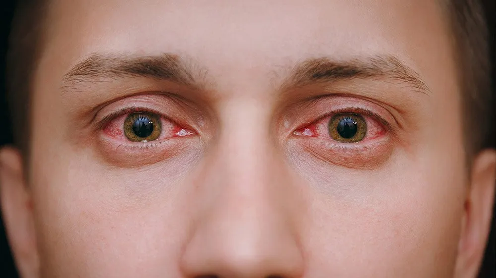 Close-up-of-two-annoyed-red-blood-eyes-of-male-Contact-Lenses-and-Eye-Infections-ss-feat