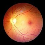 diabetes-retinopathy-What-Is-a-Macular-Hole-as-feat