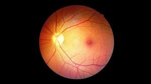 diabetes-retinopathy-What-Is-a-Macular-Hole-as-feat