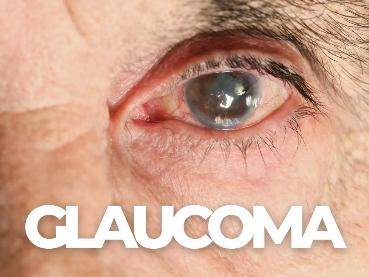 Glaucoma - Bệnh tăng nhãn áp