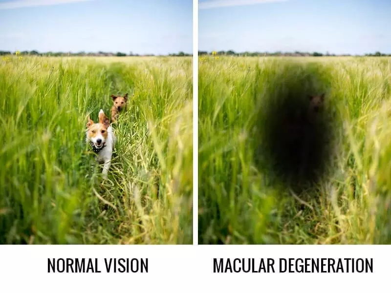 macular-degeneration