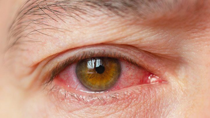 what-is-dry-eye-symptoms-treatment-causes