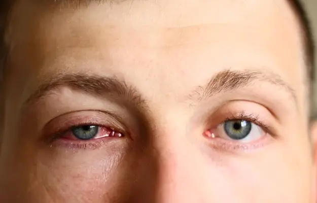 Effective Red Eye Treatment