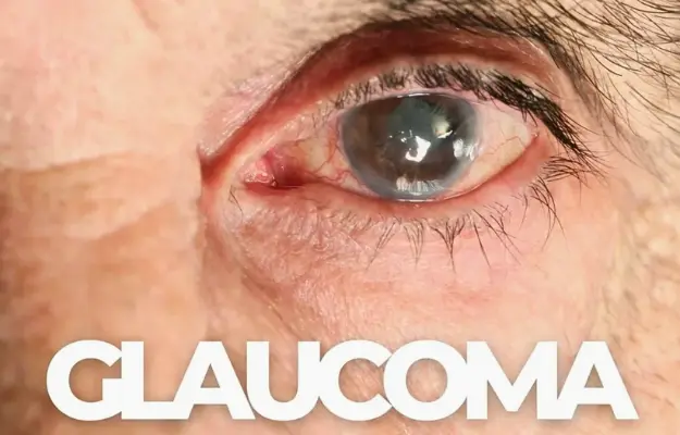 Glaucoma Treatment