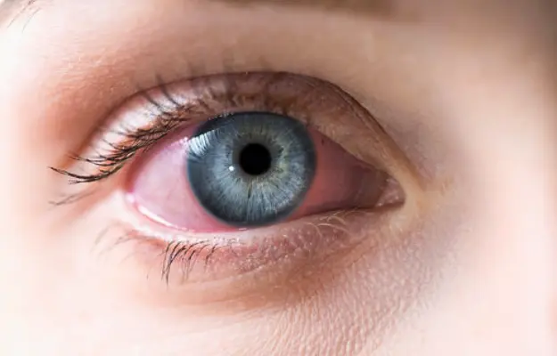 What is Red Eye?