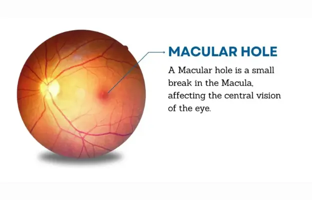 Lỗ Hoàng Điểm (Macular Hole) Là Gì?