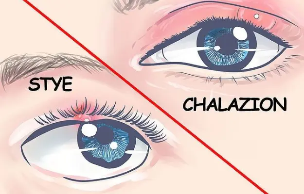 Distinguishing a Stye from a Chalazion