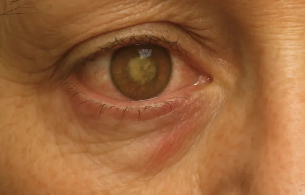 Age-Related Macular Degeneration (AMD)