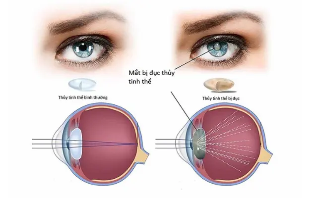 Đục thủy tinh thể là gì?